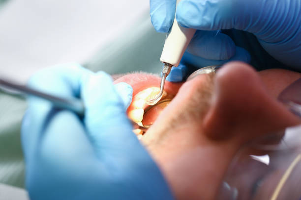 Best Emergency Dentist for Lost Fillings or Crowns in Weston, WV